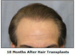 Hair Restoration By Dr Luciano Sztulman After Picture