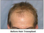 Hair Restoration Before Picture
