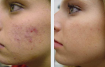 Skinsational Rosacea Acne Treatment